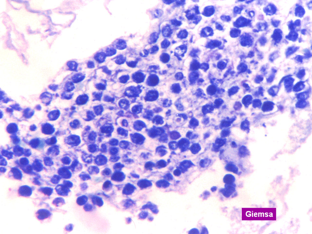 Fig.20: PEL. Giemsa. - <div style=